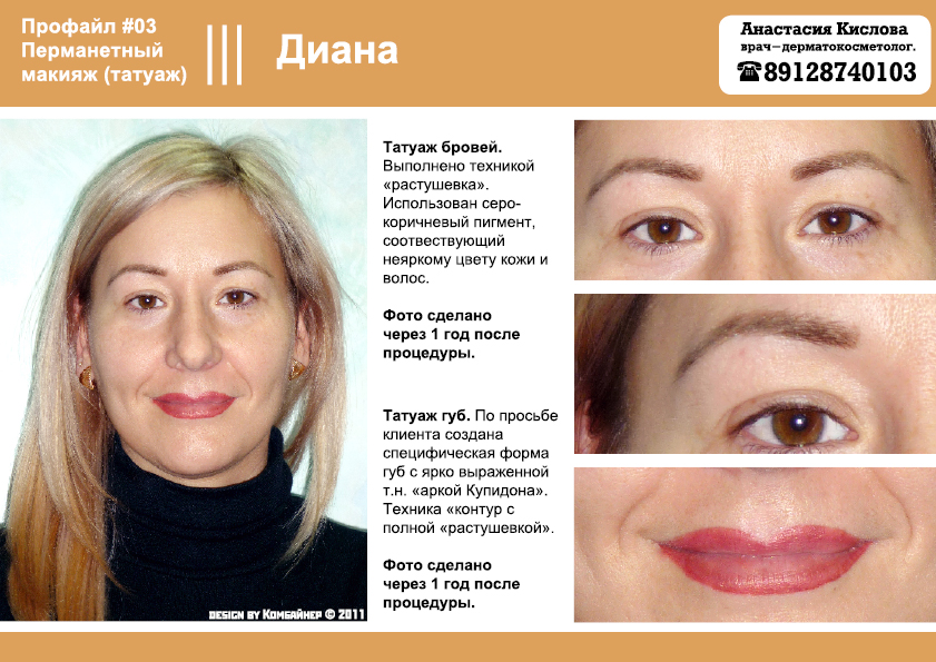 Опускается ли нос после ринопластики: причины, которые могут Кариес и инфекции кариозных полостей (ишемический остеонекроз)