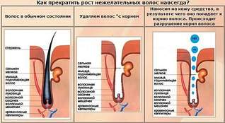 604 X 330 56.3 Kb 1414 X 2000 862.3 Kb 350 X 350 28.3 Kb Как удалить волосы навсегда в домашних условиях