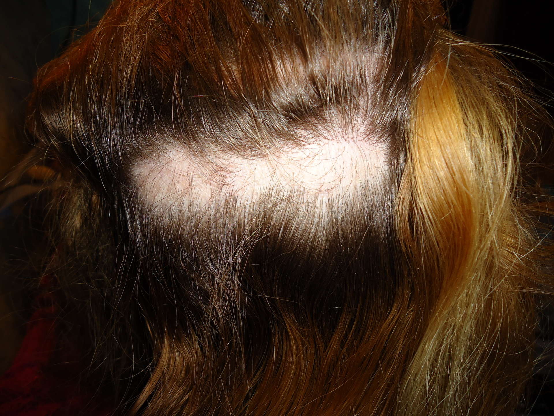 Выпадают волосы после покраски. Волосы после наращивания. Последствия наращивания волос. После нарощенных волос. Нарощенные волосы последствия.