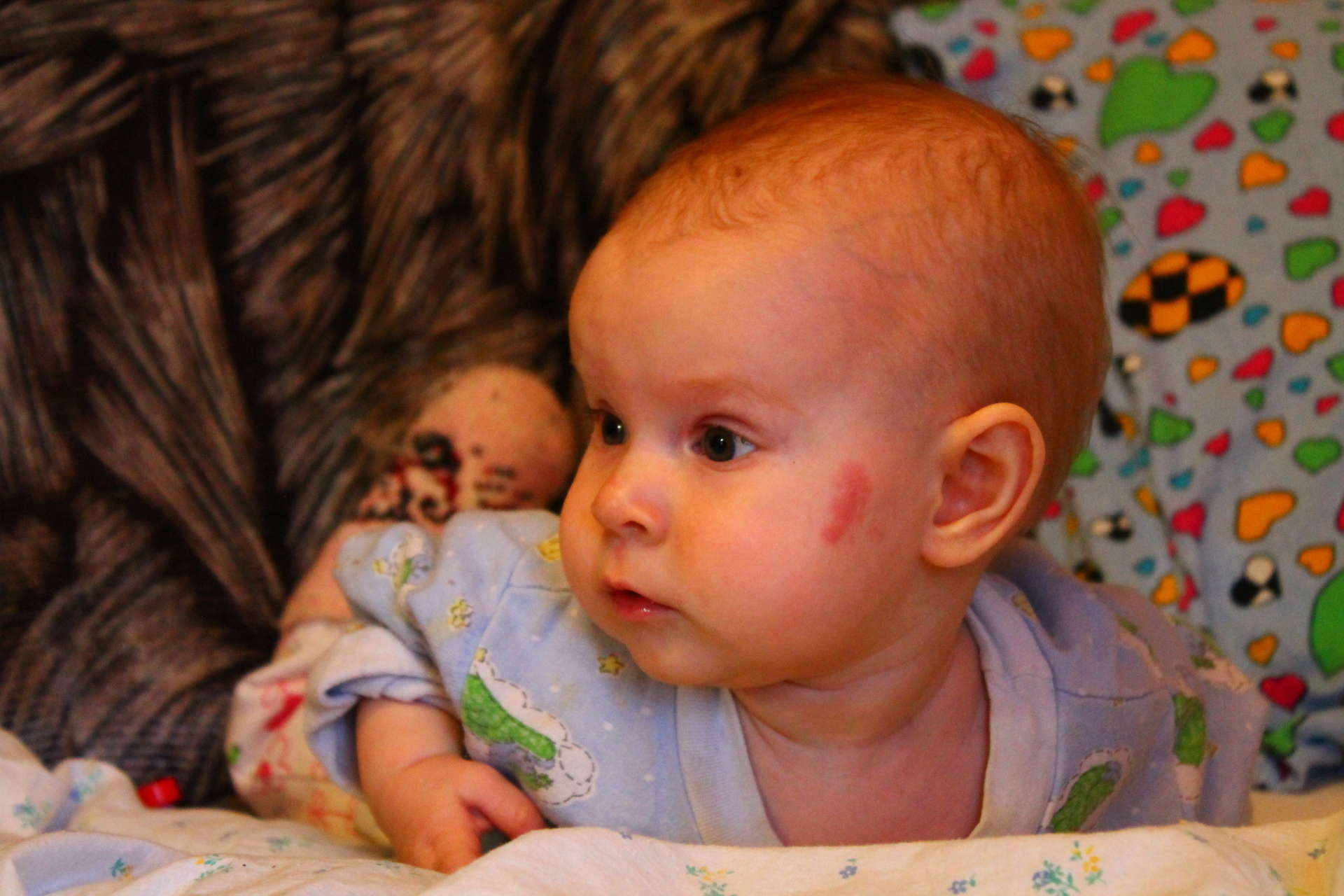 Маленький затылок. Родимое пятно на голове у младенца. У новорожденного ребенка родимое пятно на лице. Красное родимое пятно на лице новорожденного.